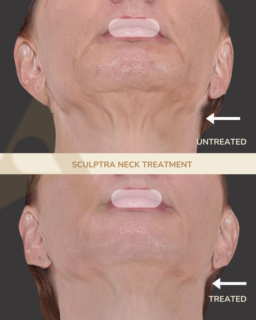 Sculptra Neck Treatment at Altaderma Clinic