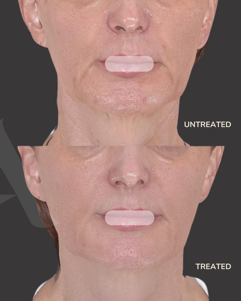 Sculptra Treatment at Altaderma Clinic & Training Center