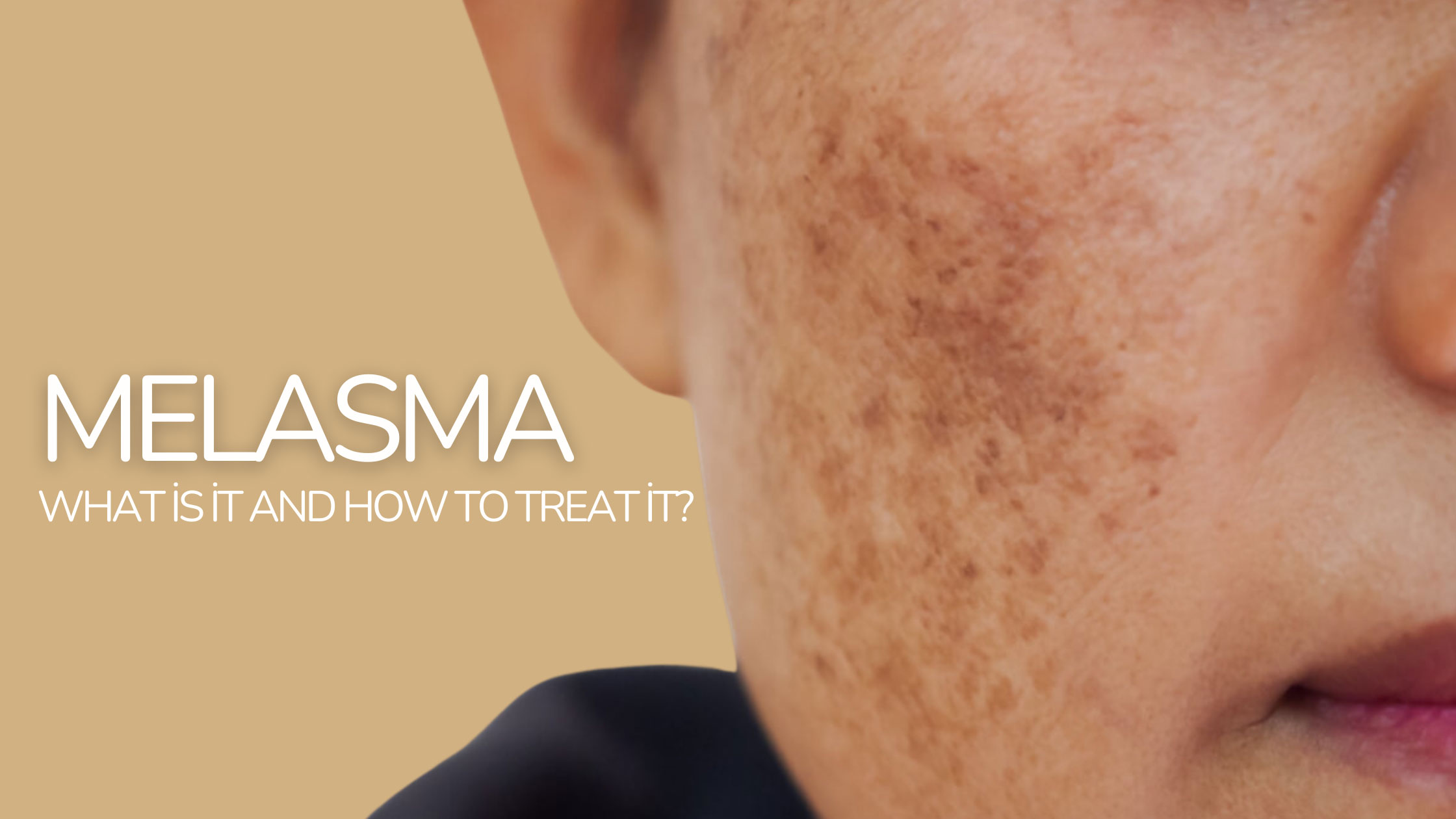 Melasma